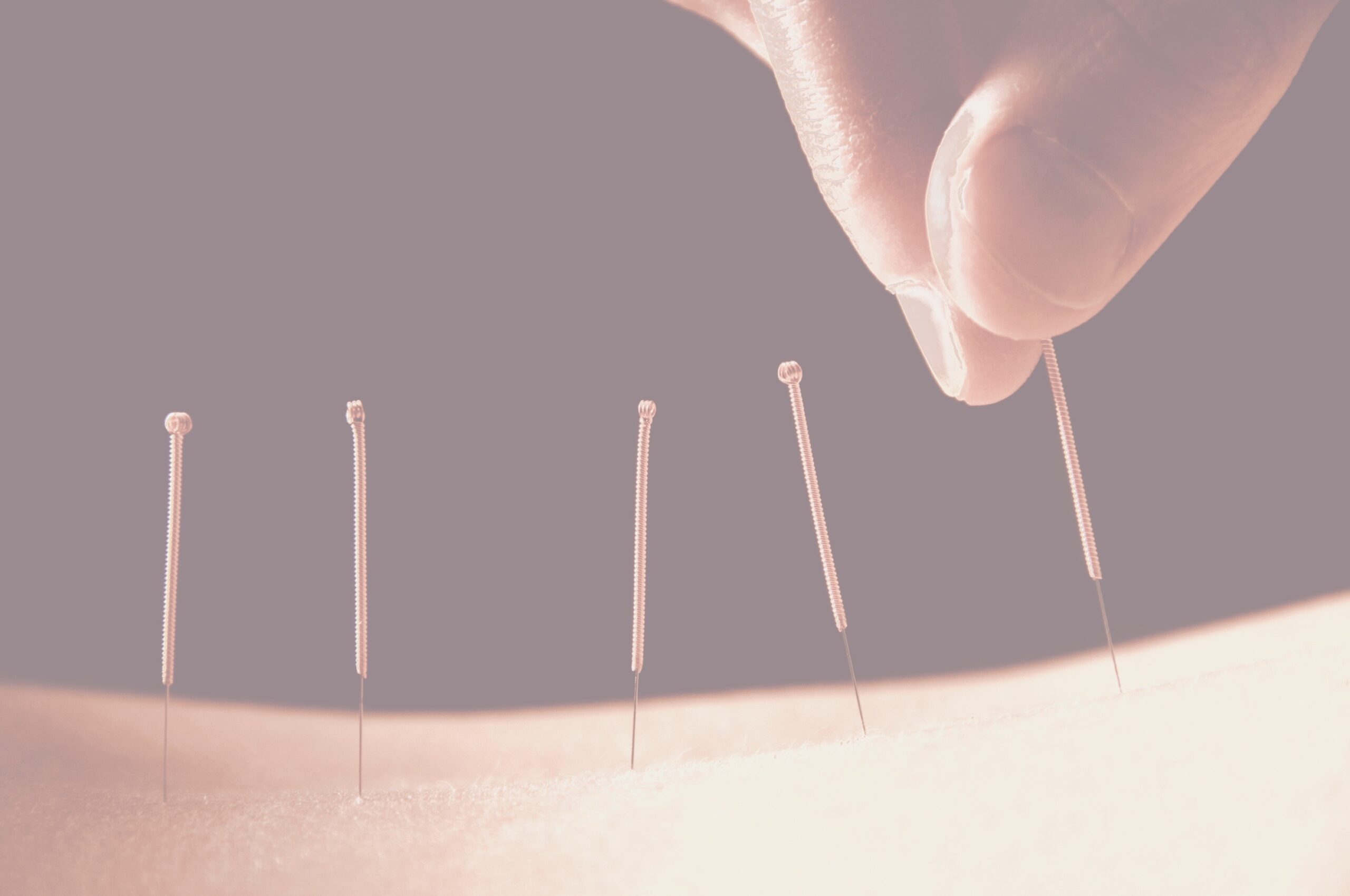 Acupuncture