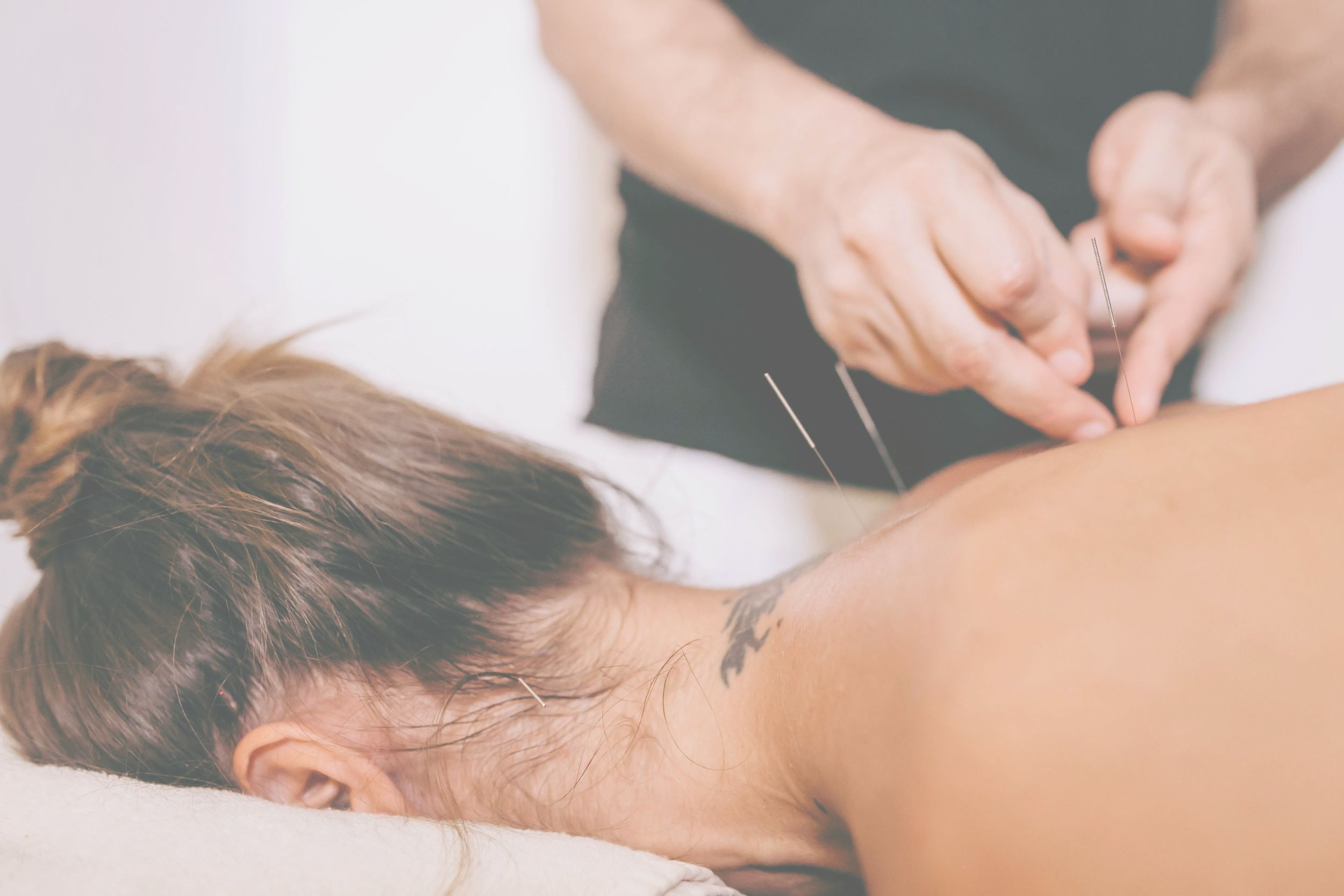 Dry Needling